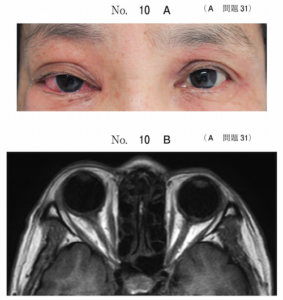 内頸動脈海綿静脈洞瘻(CCF)112回医師国家試験A問題31