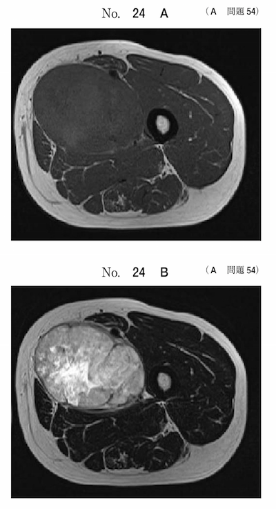 悪性軟部腫瘍のMRI画像診断-112回医師国家試験A問題54