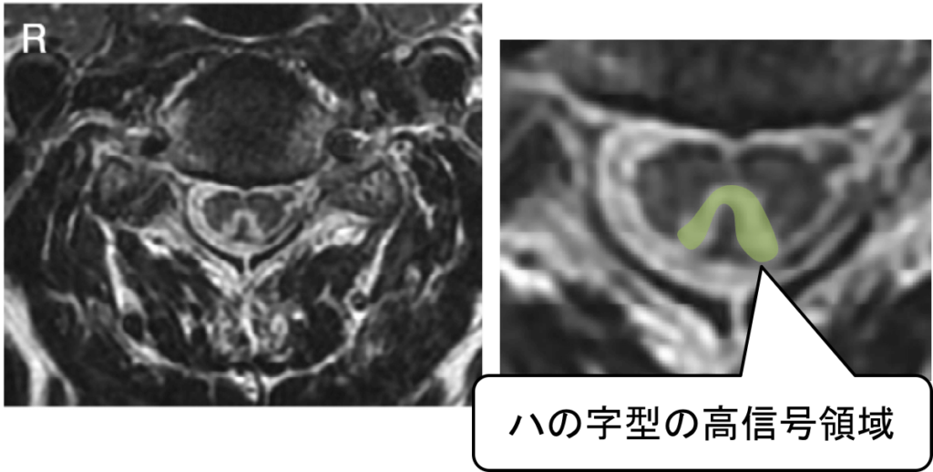亜急性連合性脊髄変性症-112回医師国家試験A問題19