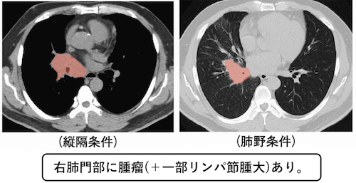 肺門部肺癌の診断-112回医師国家試験B問題38