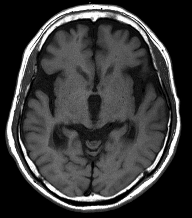 120A16の頭部単純MRI T1強調横断像