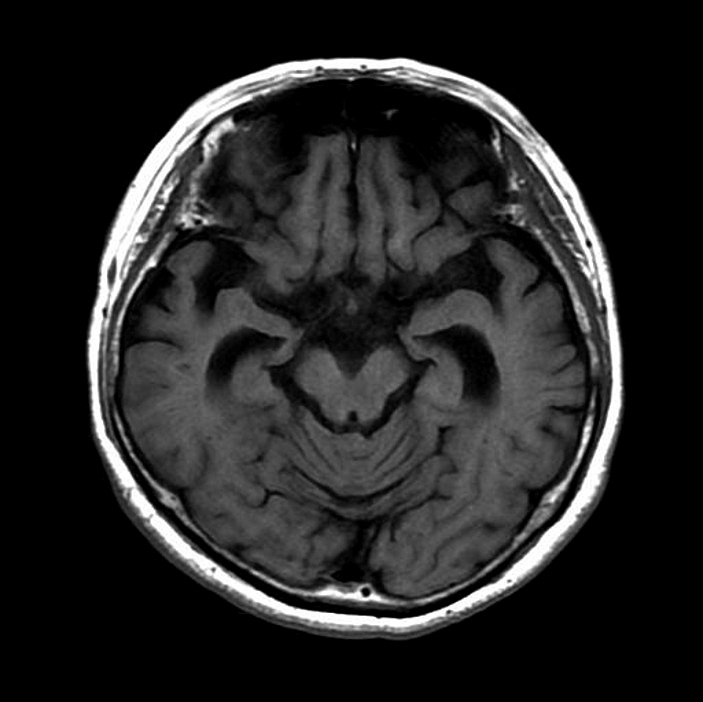 第120回医師国家試験A21・A:頭部単純MRI・T1強調像