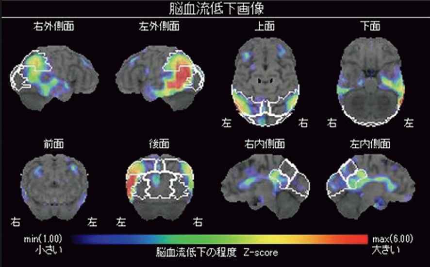 第120回医師国家試験A21・B:脳血流低下の程度を示す解析画像