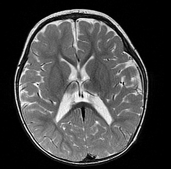 第120回医師国家試験A46・頭部MRI・T2強調像：下方の断面