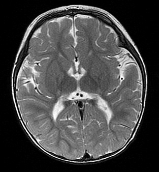 第120回医師国家試験A46・頭部MRI・T2強調像：側脳室周囲を確認する断面
