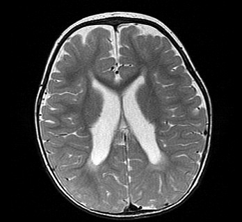 第120回医師国家試験A46・頭部MRI・T2強調像：側脳室体部の断面