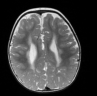 第120回医師国家試験A46・頭部MRI・T2強調像：さらに上方の断面