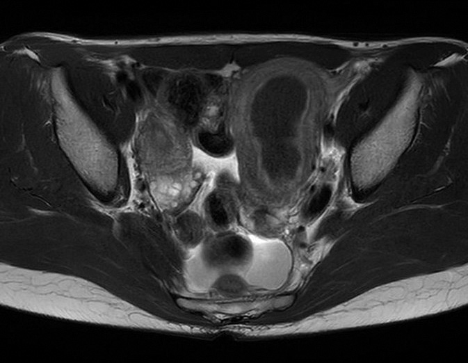 第120回医師国家試験A67・骨盤部単純MRI・T2強調像