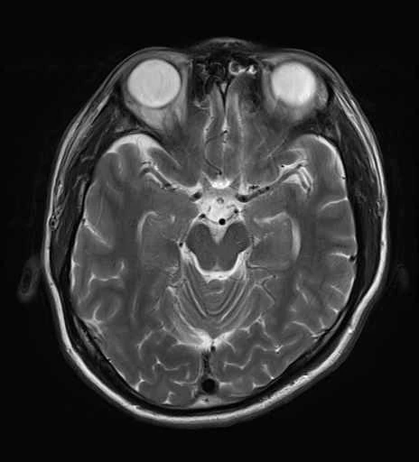 正常例の頭部MRI T2強調横断像。中脳の位置を確認するための参考画像
