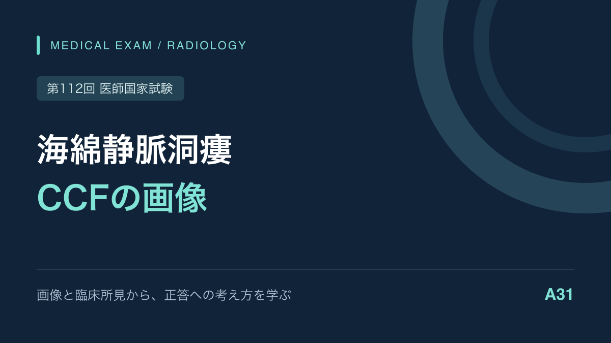 充血・複視・眼窩部雑音｜頸動脈海綿静脈洞瘻の画像｜第112回医師国家試験A31